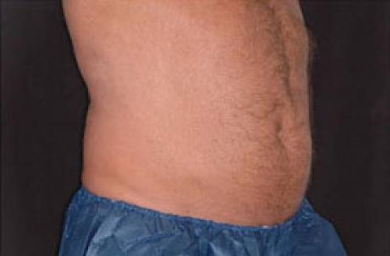 CoolSculpting Before & After Gallery - Patient 281637 - Image 3