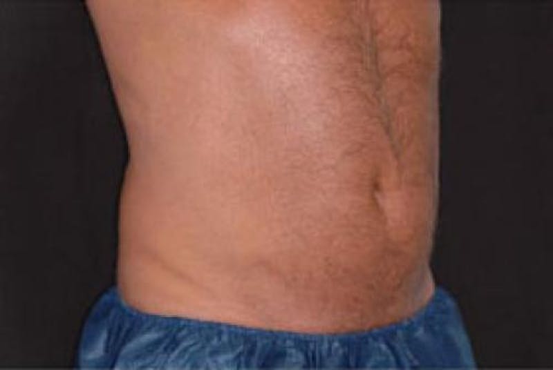 CoolSculpting Before & After Gallery - Patient 281637 - Image 4