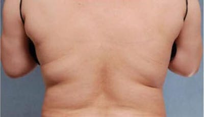 CoolSculpting Before & After Gallery - Patient 250985 - Image 1