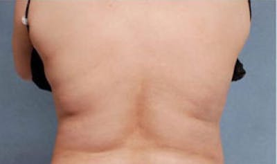 CoolSculpting Before & After Gallery - Patient 250985 - Image 2