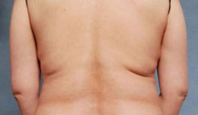 CoolSculpting Before & After Gallery - Patient 216307 - Image 1