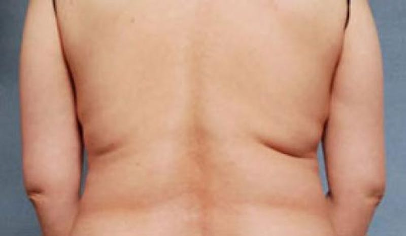 CoolSculpting Before & After Gallery - Patient 216307 - Image 1