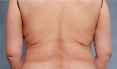 CoolSculpting Before & After Gallery - Patient 216307 - Image 2