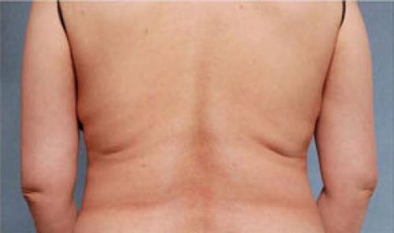 CoolSculpting Before & After Gallery - Patient 216307 - Image 2