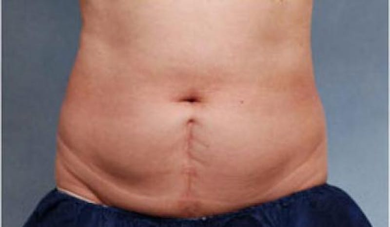 CoolSculpting Before & After Gallery - Patient 216307 - Image 3