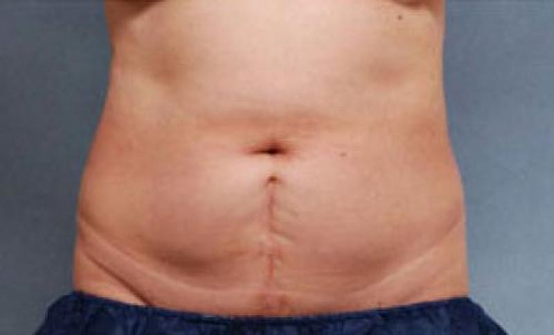 CoolSculpting Before & After Gallery - Patient 216307 - Image 4