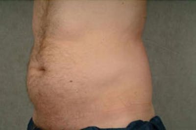 CoolSculpting Before & After Gallery - Patient 227719 - Image 1