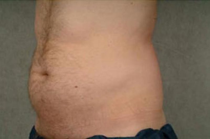 CoolSculpting Before & After Gallery - Patient 227719 - Image 1