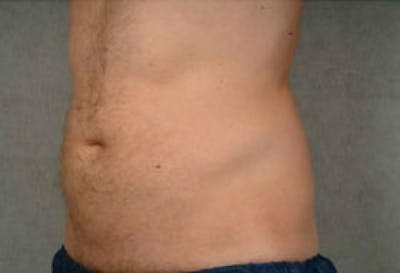 CoolSculpting Before & After Gallery - Patient 227719 - Image 2