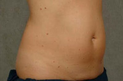 CoolSculpting Before & After Gallery - Patient 382570 - Image 1