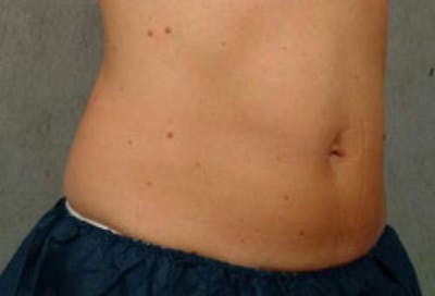 CoolSculpting Before & After Gallery - Patient 382570 - Image 2