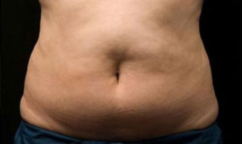 CoolSculpting Before & After Gallery - Patient 383230 - Image 1
