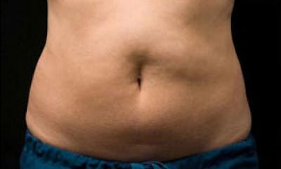 CoolSculpting Before & After Gallery - Patient 383230 - Image 2
