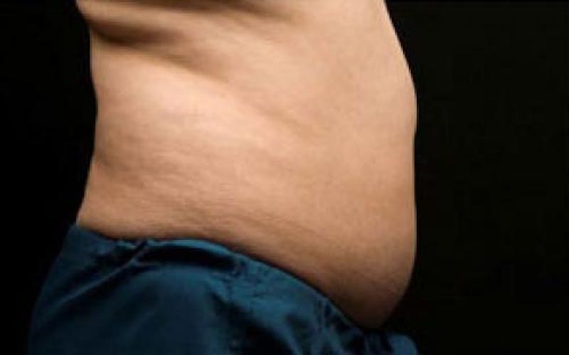 CoolSculpting Before & After Gallery - Patient 383230 - Image 3