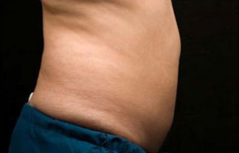 CoolSculpting Before & After Gallery - Patient 383230 - Image 4