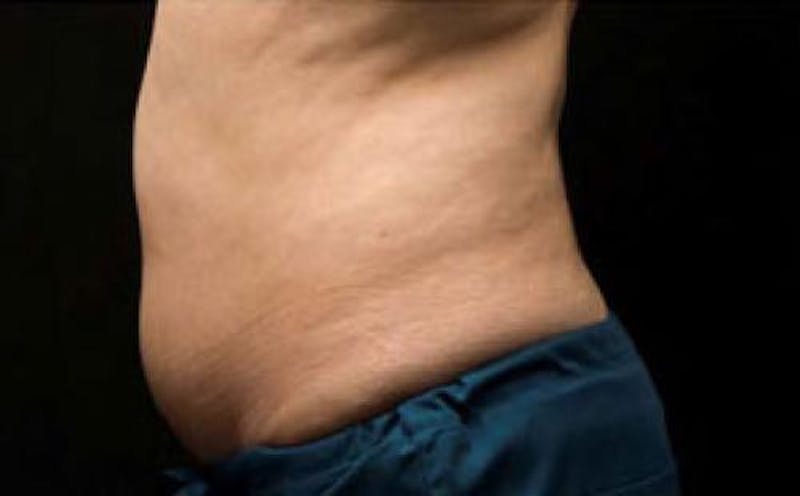 CoolSculpting Before & After Gallery - Patient 383230 - Image 5