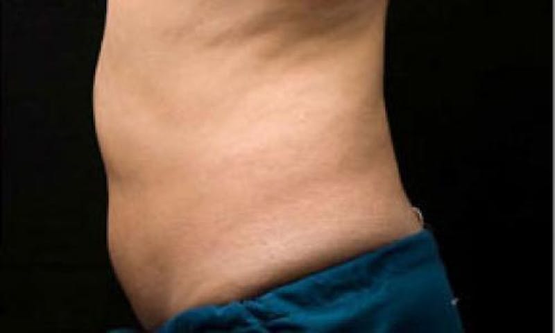 CoolSculpting Before & After Gallery - Patient 383230 - Image 6