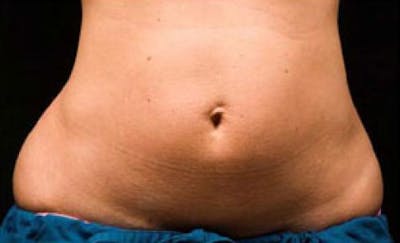 CoolSculpting Before & After Gallery - Patient 121594 - Image 1