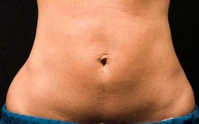 CoolSculpting Before & After Gallery - Patient 121594 - Image 2