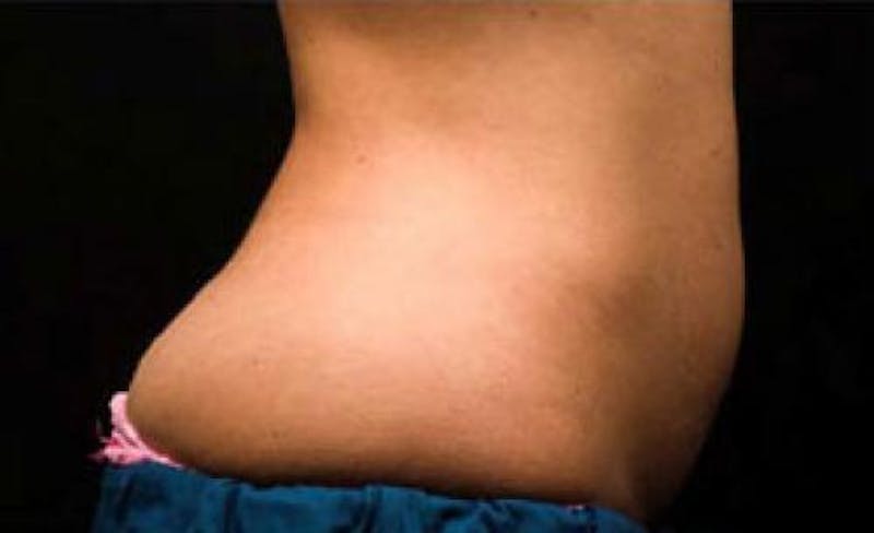 CoolSculpting Before & After Gallery - Patient 121594 - Image 3