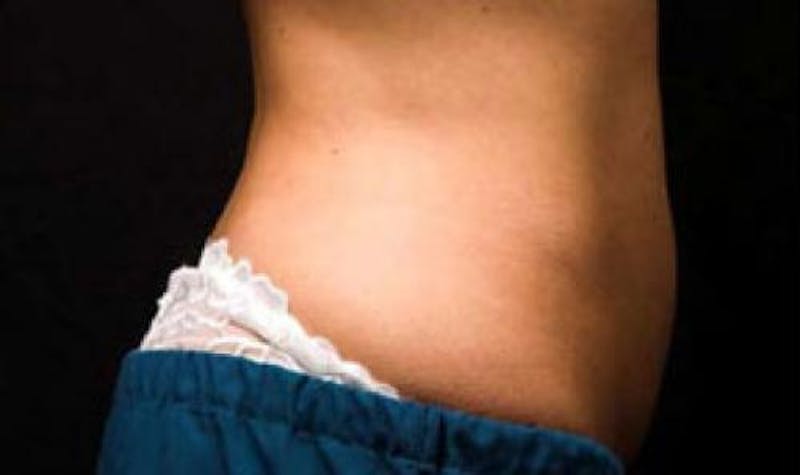 CoolSculpting Before & After Gallery - Patient 121594 - Image 4