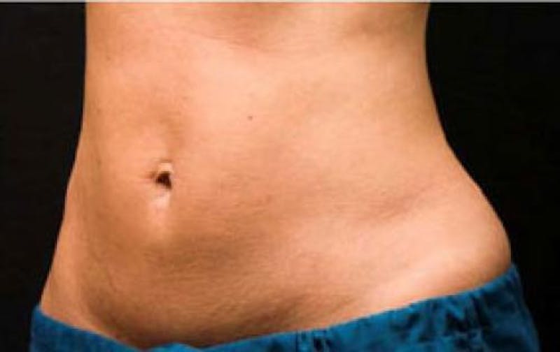 CoolSculpting Before & After Gallery - Patient 121594 - Image 6