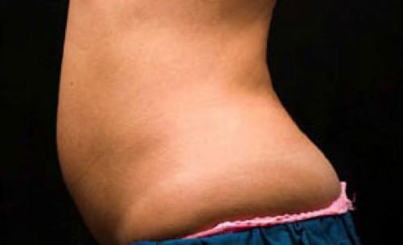 CoolSculpting Before & After Gallery - Patient 121594 - Image 7