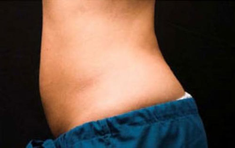 CoolSculpting Before & After Gallery - Patient 121594 - Image 8