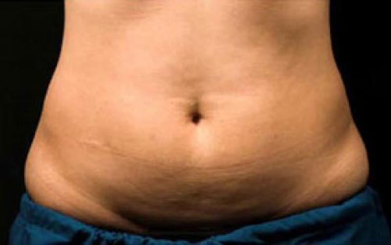 CoolSculpting Before & After Gallery - Patient 243825 - Image 1