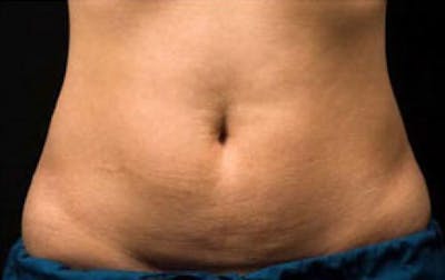 CoolSculpting Before & After Gallery - Patient 243825 - Image 2