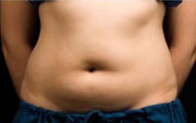 CoolSculpting Before & After Gallery - Patient 152130 - Image 1