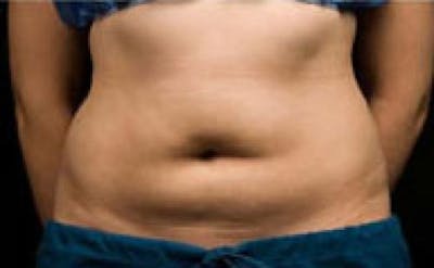 CoolSculpting Before & After Gallery - Patient 152130 - Image 2