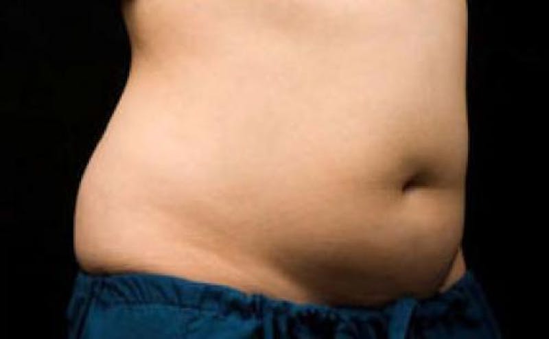 CoolSculpting Before & After Gallery - Patient 152130 - Image 3