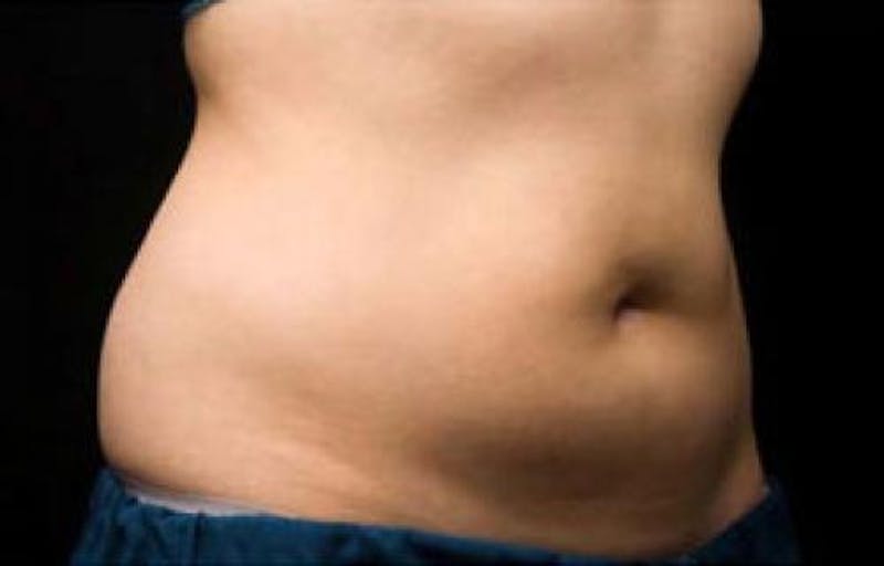 CoolSculpting Before & After Gallery - Patient 152130 - Image 4