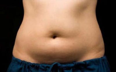 CoolSculpting Before & After Gallery - Patient 395469 - Image 1