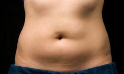 CoolSculpting Before & After Gallery - Patient 395469 - Image 2