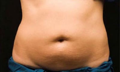 CoolSculpting Before & After Gallery - Patient 396712 - Image 1