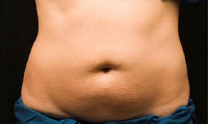 CoolSculpting Before & After Gallery - Patient 396712 - Image 1