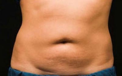 CoolSculpting Before & After Gallery - Patient 396712 - Image 2