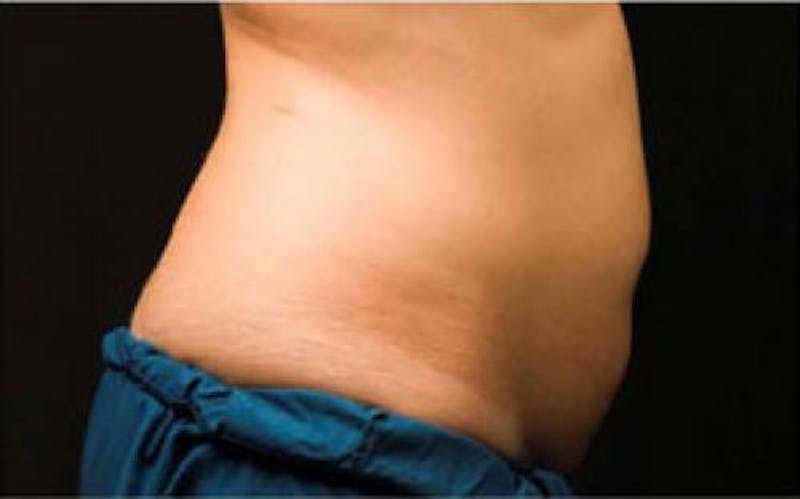 CoolSculpting Before & After Gallery - Patient 396712 - Image 3