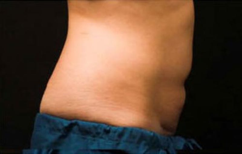 CoolSculpting Before & After Gallery - Patient 396712 - Image 4
