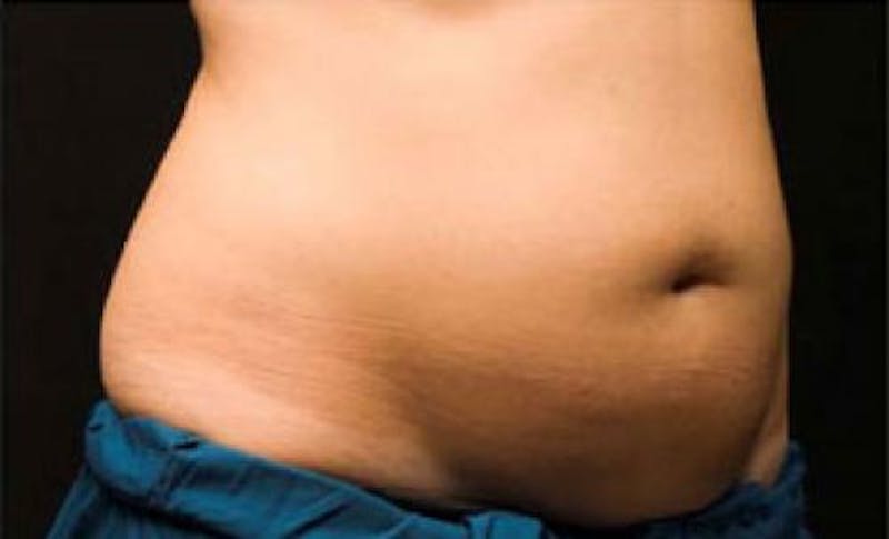 CoolSculpting Before & After Gallery - Patient 396712 - Image 5