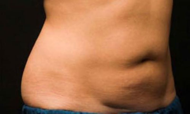 CoolSculpting Before & After Gallery - Patient 396712 - Image 6
