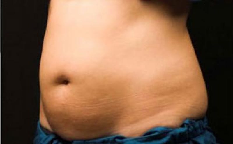 CoolSculpting Before & After Gallery - Patient 396712 - Image 7