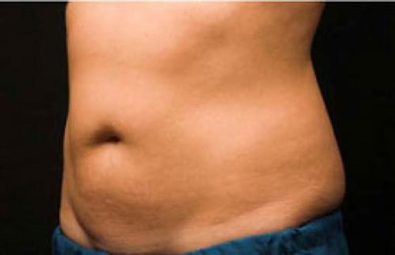 CoolSculpting Before & After Gallery - Patient 396712 - Image 8