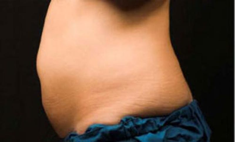 CoolSculpting Before & After Gallery - Patient 396712 - Image 9