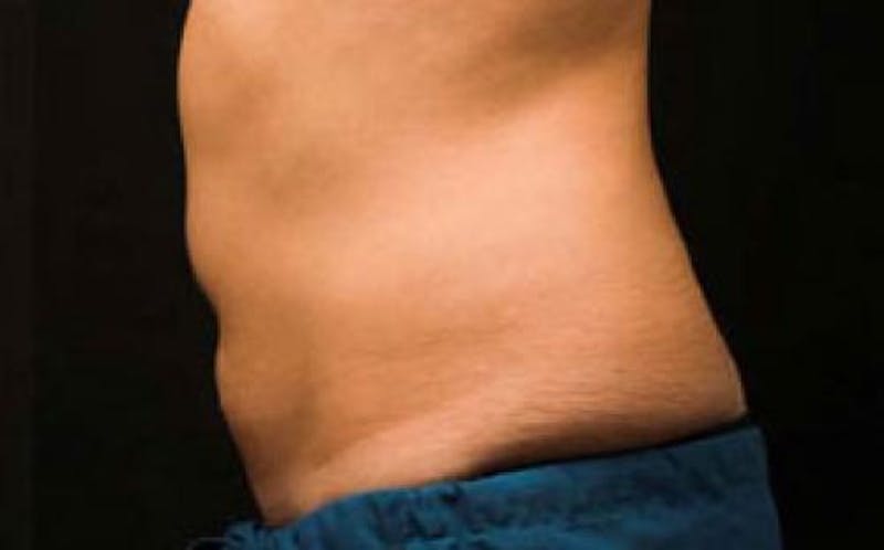CoolSculpting Before & After Gallery - Patient 396712 - Image 10