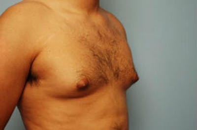 Male Procedures by Dr. Hess Before & After Gallery - Patient 134465 - Image 1