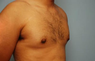 Male Procedures by Dr. Hess Before & After Gallery - Patient 134465 - Image 2