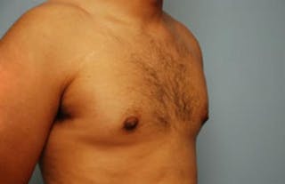 Male Breast Reduction Before & After Gallery - Patient 134465 - Image 4